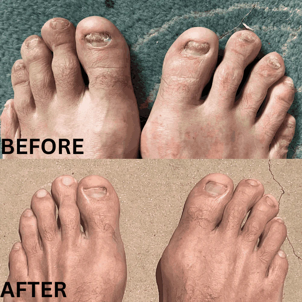 Swissclear™ LLLT Device + Free Fungal Patches