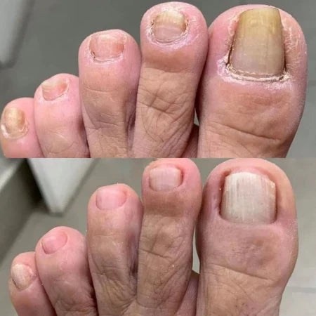 SwissClear Foot Soak - Your path to healthier Nails