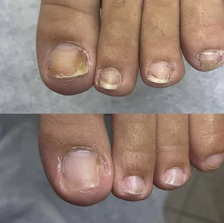 SwissClear Foot Soak - Your path to healthier Nails