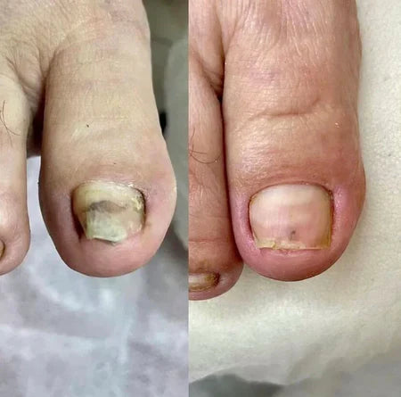 SwissClear Foot Soak - Your path to healthier Nails