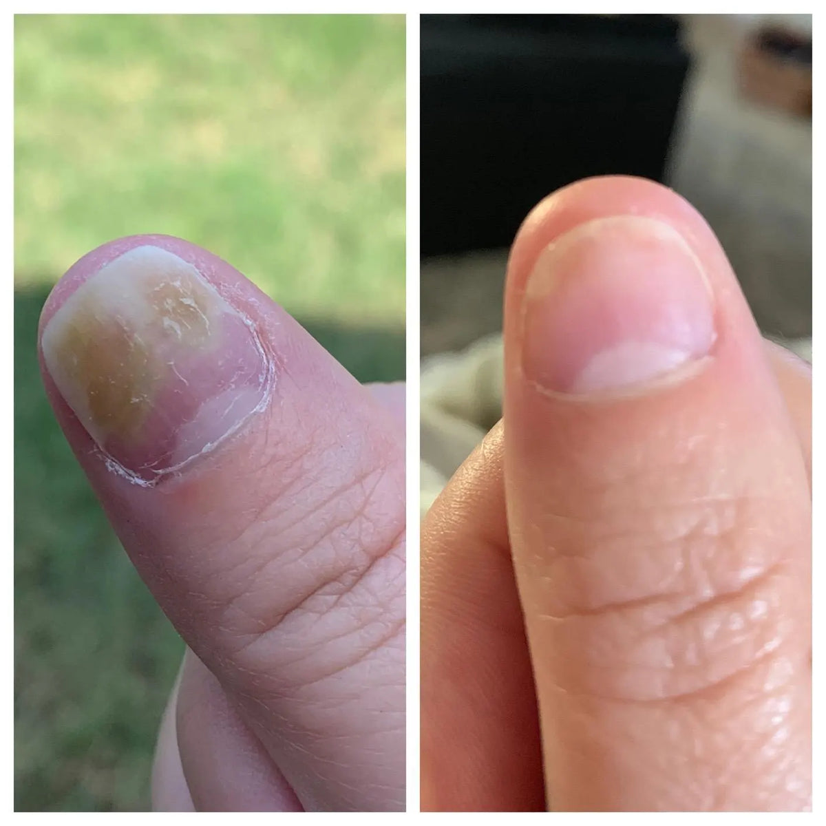 Swissclear™ LLLT Device + Free Fungal Patches