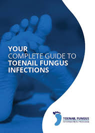 E-Book : Toenail Fungus Guide (Valued at 14.95£)