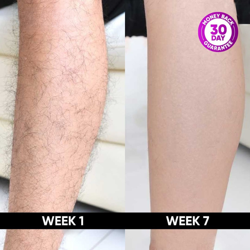LumiSmooth Hair Removal Device