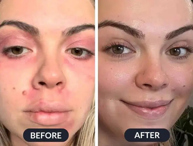 Swissclear Eczema Relief Cream