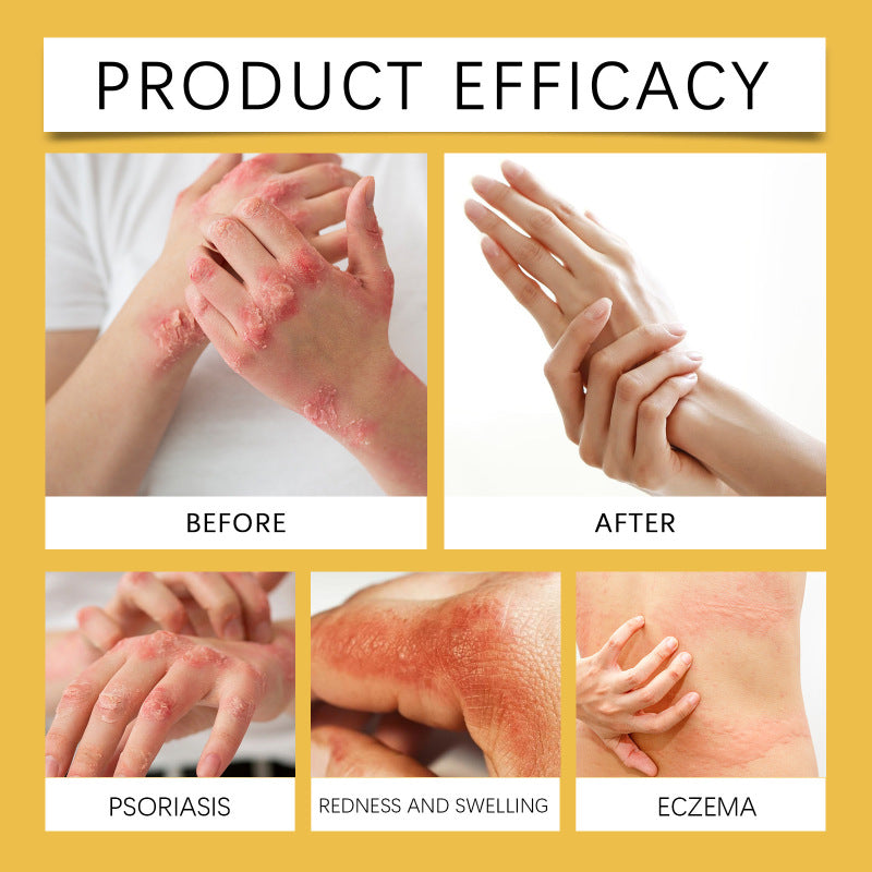 Swissclear Eczema Relief Cream